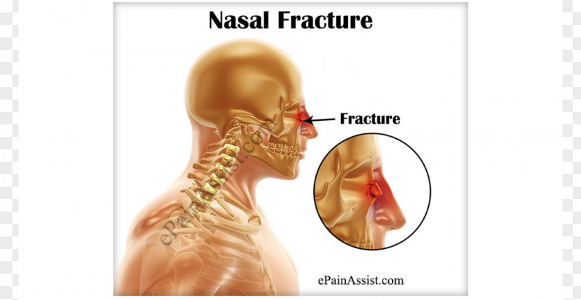 Headache Nasal Fracture Nose Bone Surgery PNG