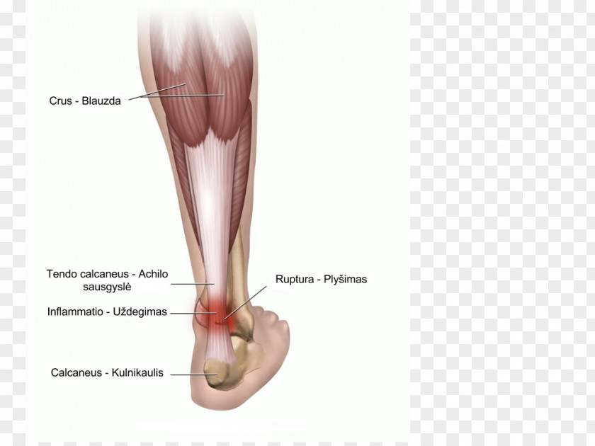 Achilles Tendinitis Tendon Achilles' Heel PNG