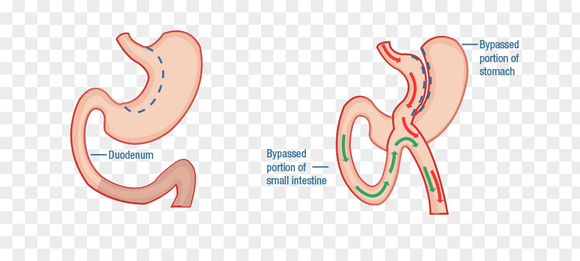 Diabetes Mellitus Type 2 Duodenal Switch Bariatric Surgery Duodenum Gastric Bypass PNG