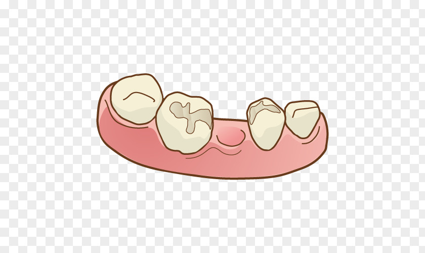 Bridge Dentist Tooth Dentures 人工歯 PNG