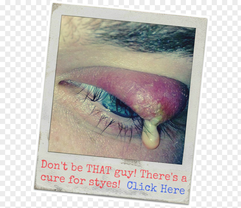 Eye Stye Eyelid Chalazion Warm Compress PNG