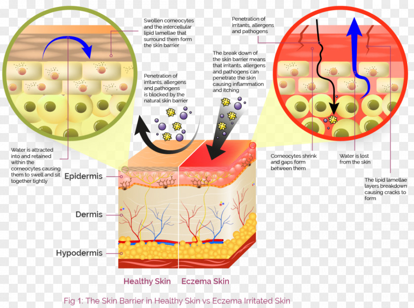 Cartoon Pathogen Contact Dermatitis Skin Seborrheic Cutaneous Condition PNG