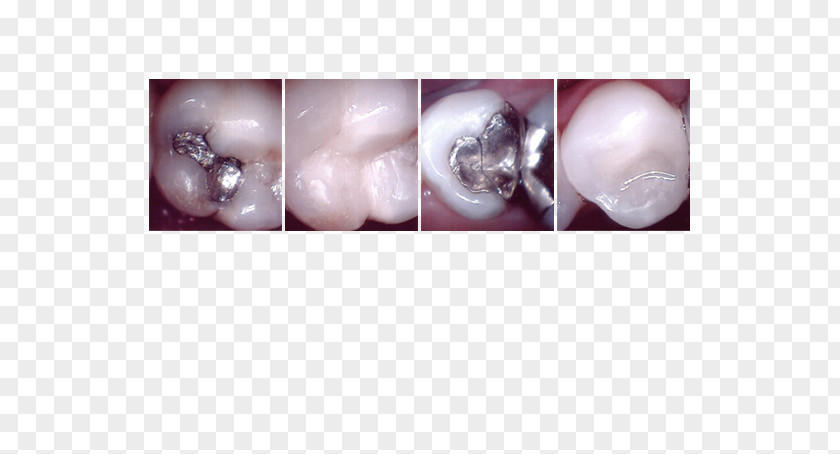 Dental Treatment Product Desktop Wallpaper Close-up Computer PNG