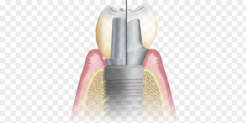 Dental Postcard Abutment Implant CAD/CAM Dentistry Implantology PNG