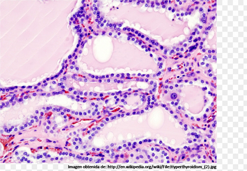 Graves' Disease Hyperthyroidism Biopsy PNG