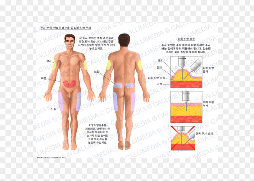 Apparatus Insulin Subcutaneous Injection Dermatology Skin PNG