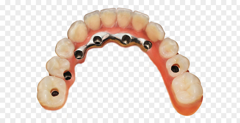 Process Tooth Dentures Crown Bridge Implantology PNG