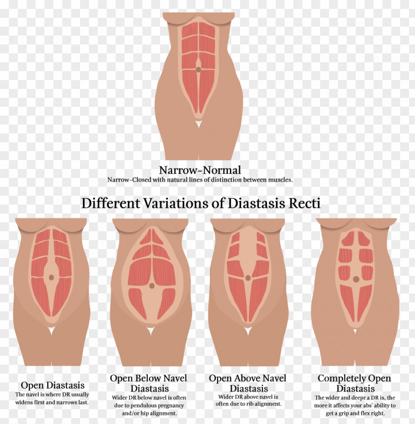 Text Plate Diastasis Recti Rectus Abdominis Muscle Abdomen Physical Therapy PNG