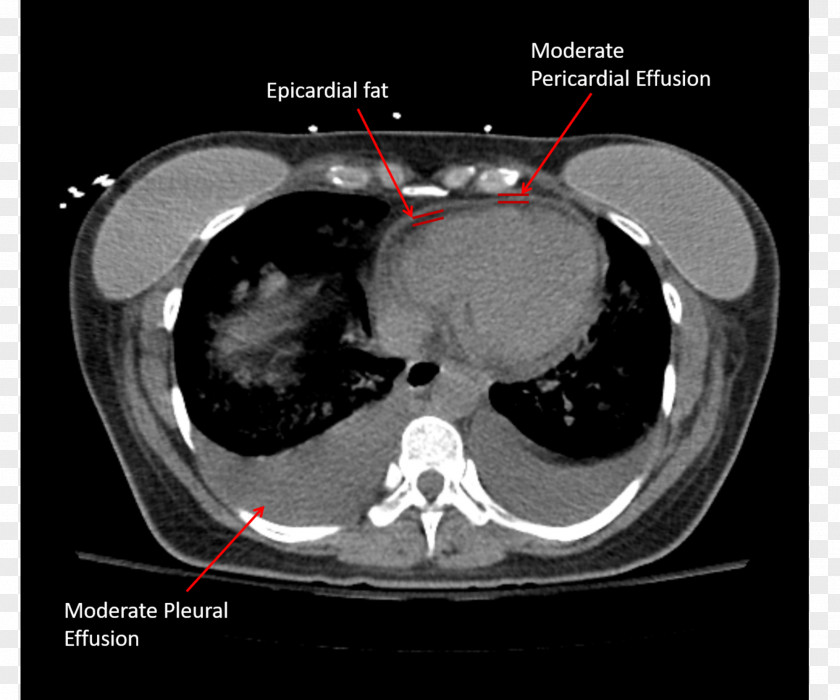 Computed Tomography Pericardial Effusion Pericardium Pericardiectomy Pericarditis PNG