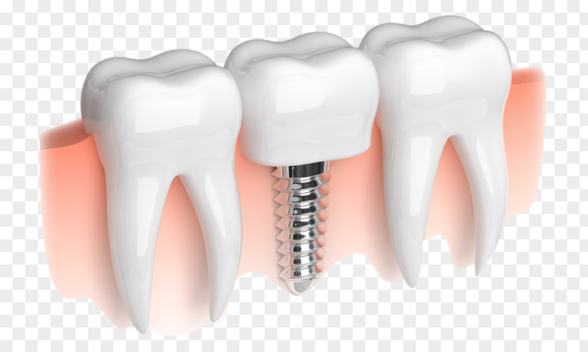 Implants Dental Implant Dentistry Smiles On State Street PNG