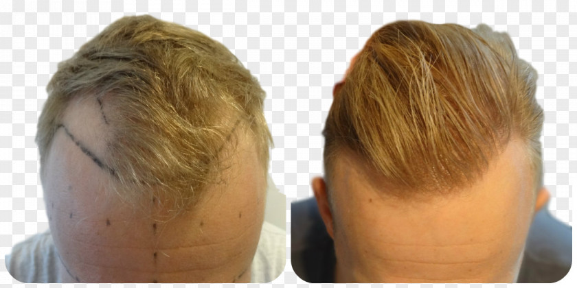 Hair Transplantation Follicular Unit Extraction Blond Graft PNG