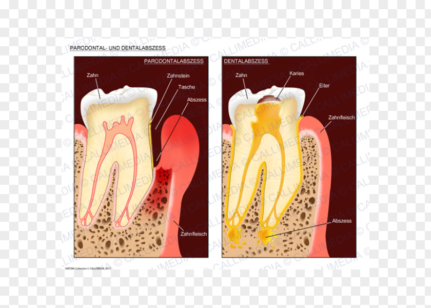 Carie Dental Abscess Periodontal Disease Gingivitis PNG