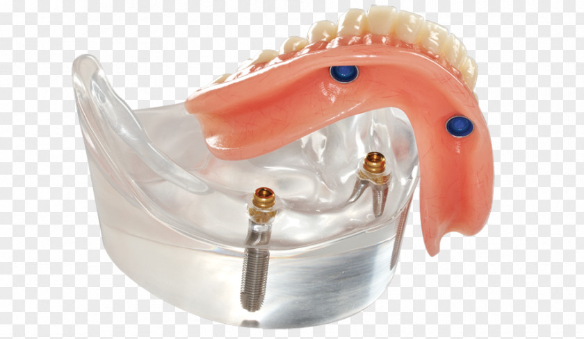 Bridge Dentures Dental Implant Dentistry Removable Partial Denture All-on-4 PNG