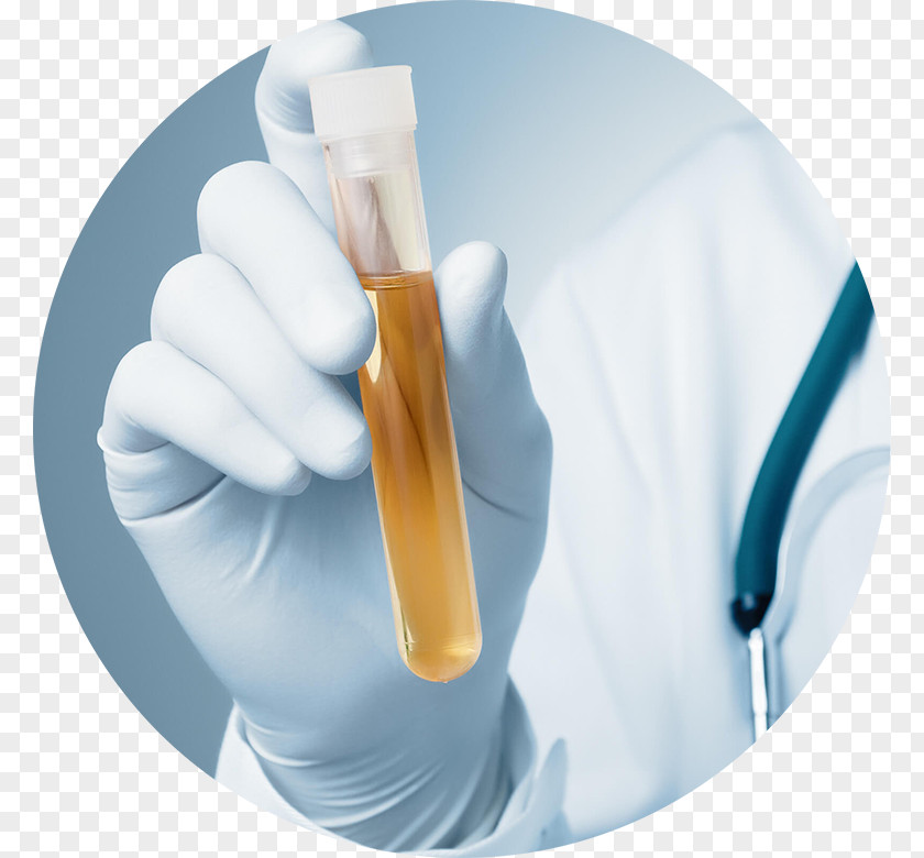 Urine Clinical Tests Urinary Tract Infection Bladder Cancer Olfaction PNG