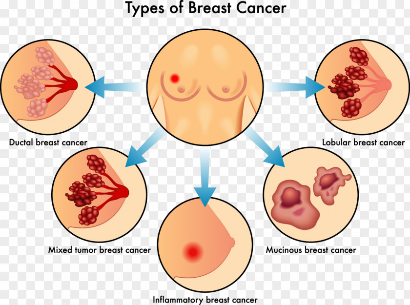 Inflammatory Breast Cancer Invasive Lobular Carcinoma PNG breast cancer lobular carcinoma, Women chest types analyzed clipart PNG