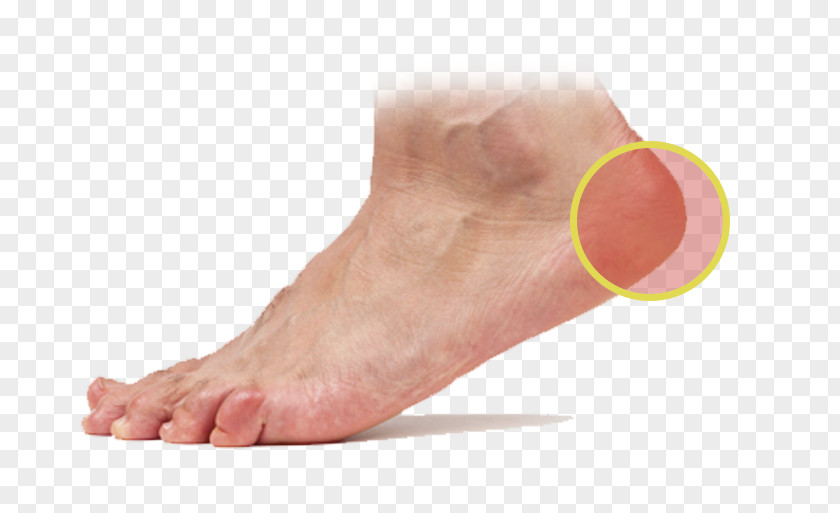 Injury Trouble Foot Podiatry Skin Plantar Fasciitis Sole PNG