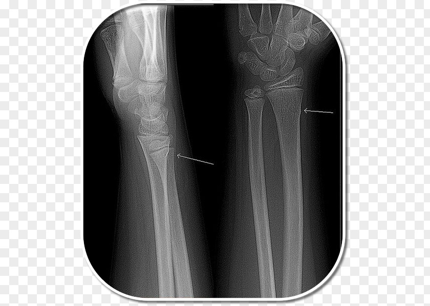 Design X-ray Shoulder Greenstick Fracture Radiography PNG