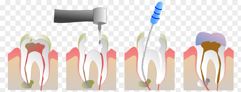 Endodontic Therapy Root Canal Pulp Endodontics Dentistry PNG
