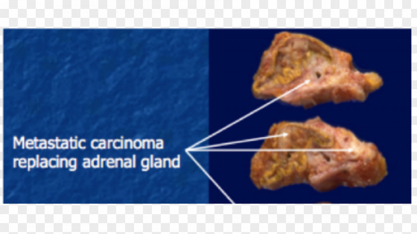 Adrenal Gland Cell Parathyroid Endocrine Pathology PNG