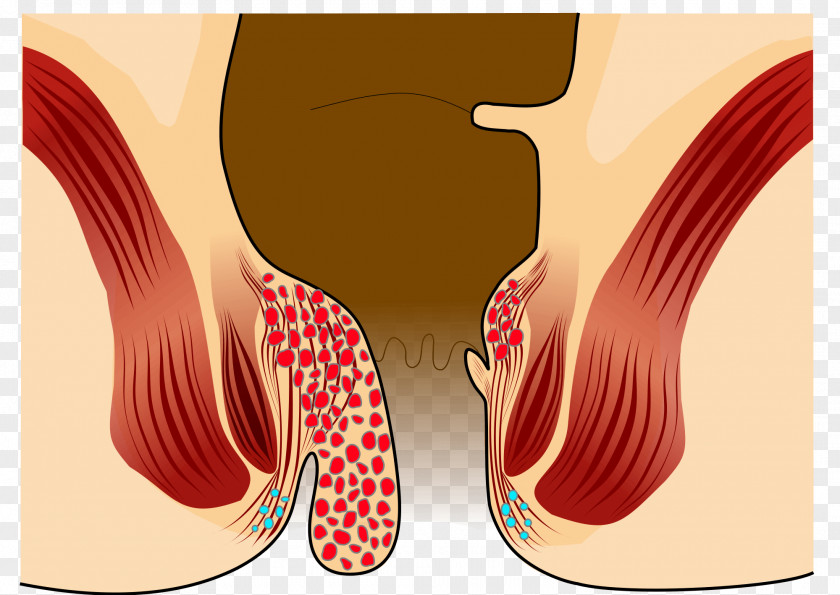 Internal Hemorrhoid Surgery Prolapse Symptom PNG Symptom, others clipart PNG