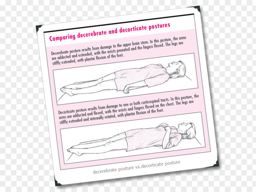 Brain Abnormal Posturing Decerebration 除脳硬直 Posture PNG