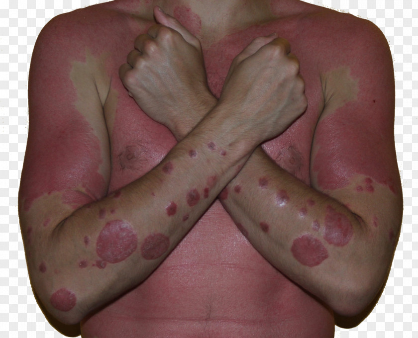 Sun Burn National Institute Of Arthritis And Musculoskeletal Skin Diseases Guttate Psoriasis PNG