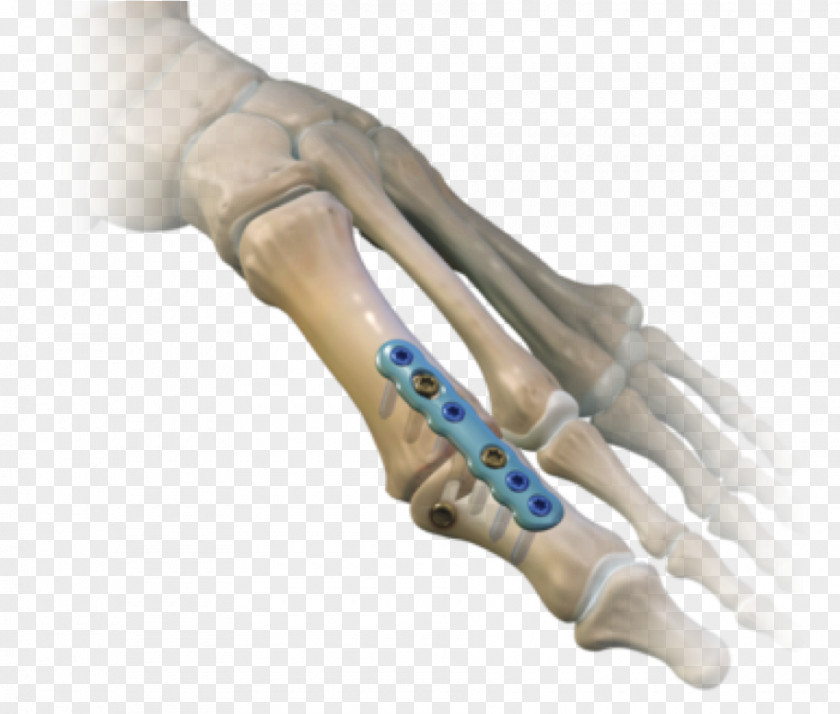 Hallux Rigidus Metatarsophalangeal Joints Arthrodesis Surgery Bunion PNG