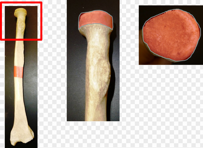 Arm Head Of Radius Radial Fracture Tuberosity Bone PNG