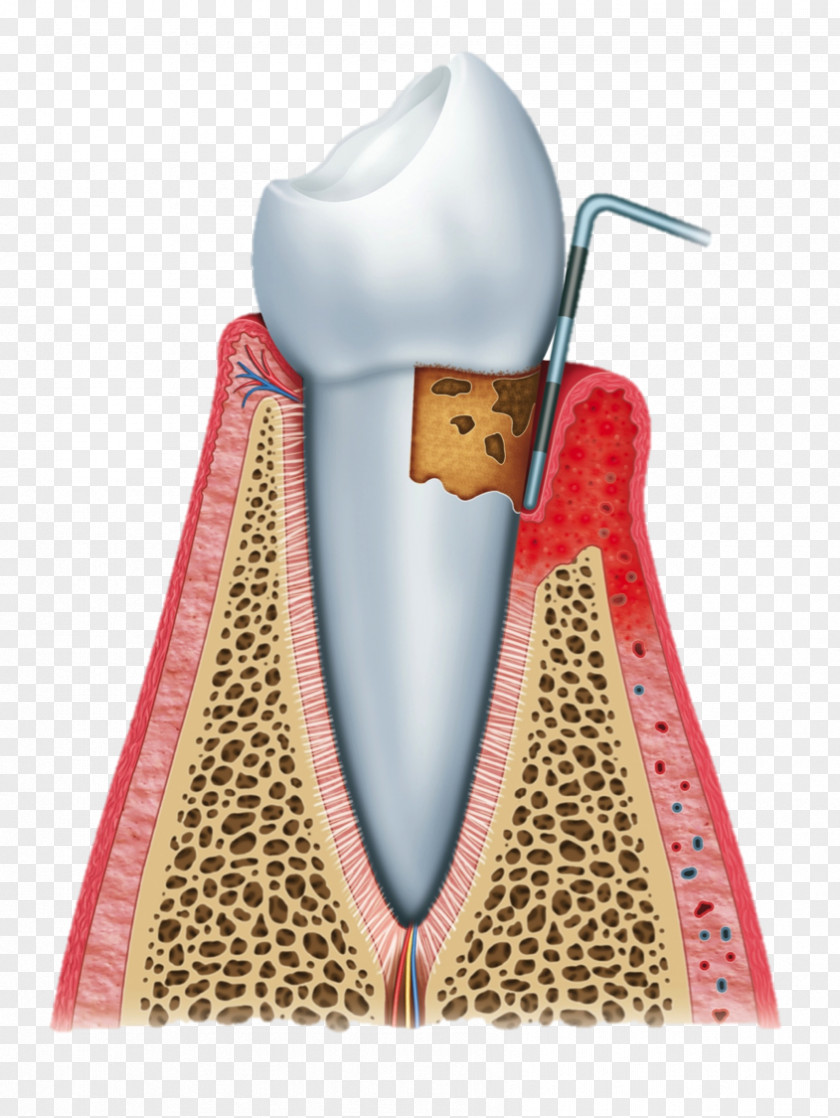 Bleeding Gums Cartoon Periodontal Disease Laser-assisted New Attachment Procedure Periodontology Gingivitis PNG