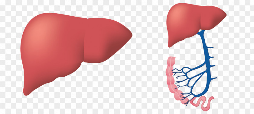 Human-liver Liver Disease Ionis Pharmaceuticals Fatty PNG