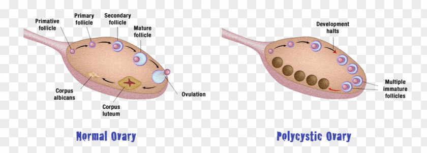 Health Polycystic Ovary Syndrome Ovarian Cyst Disease PNG