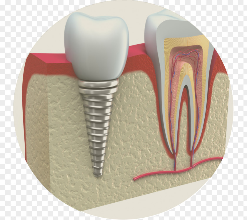 Crown Dental Implant Periodontal Disease Dentistry Periodontology PNG