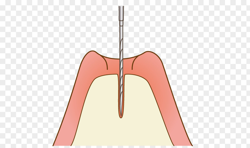 Implant Dentistry Sinus Lift Maxillary Dental Paranasal Sinuses Bone PNG
