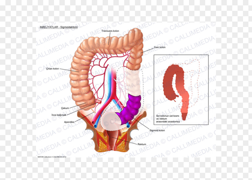 Sigmoid Colon Colorectal Cancer Surgery PNG