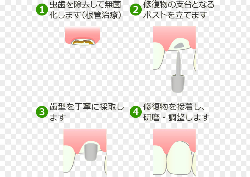 Crown 西千葉フラワー歯科医院 【稲毛区・西千葉】 Dentist 3Mix-MP法 Tooth Decay PNG