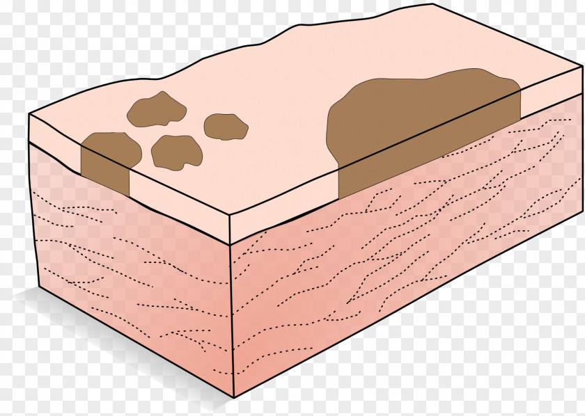 Patchwork Macule Patch Cutaneous Condition Dermatology PNG