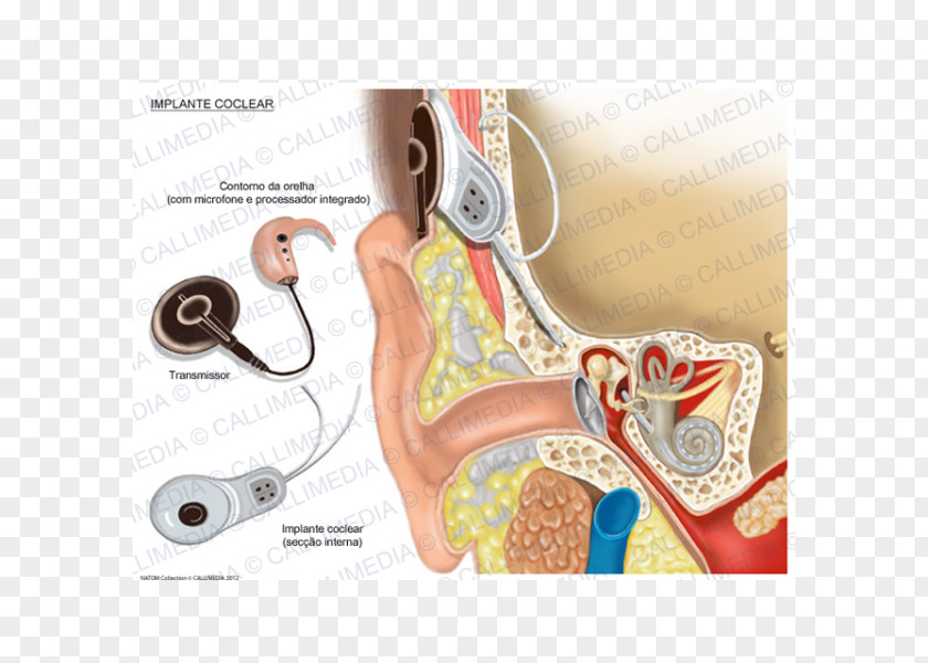 Ear Cochlear Implant Hearing PNG