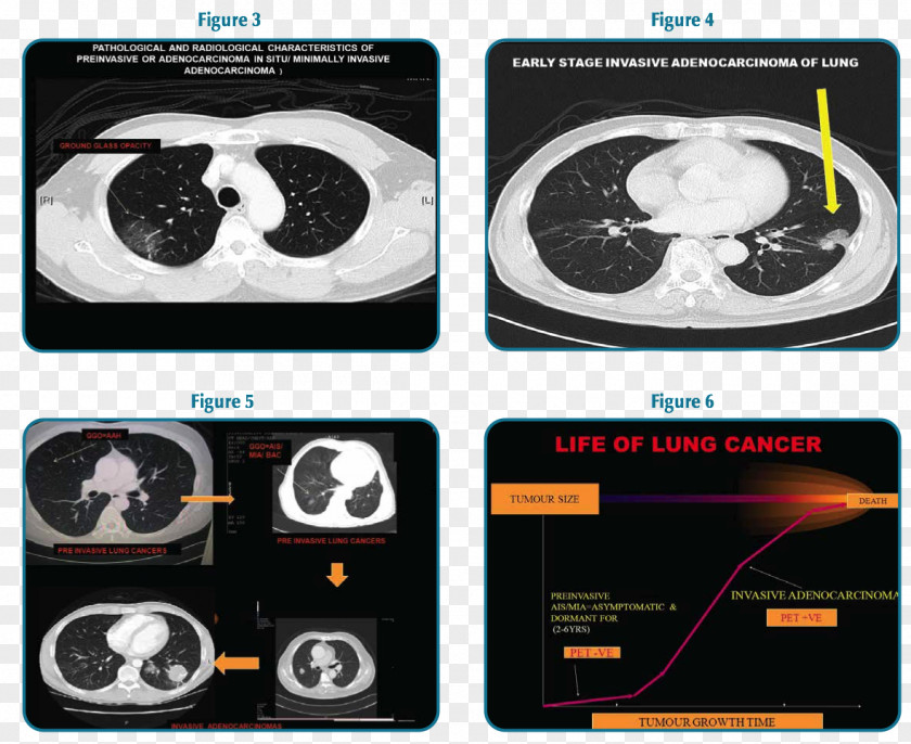 Lungs Surgery Brand Technology PNG