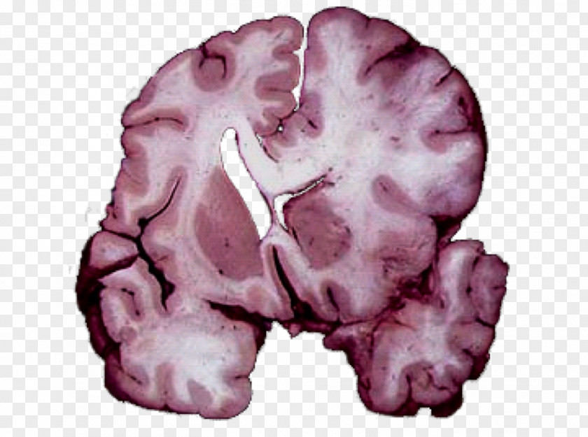 Brain Herniation Intracranial Pressure Traumatic Injury Cerebellar Tonsil PNG