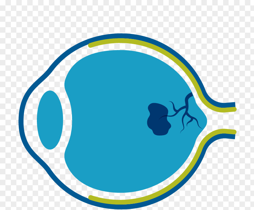 Exudative Macular Degeneration Macula Of Retina Eye PNG
