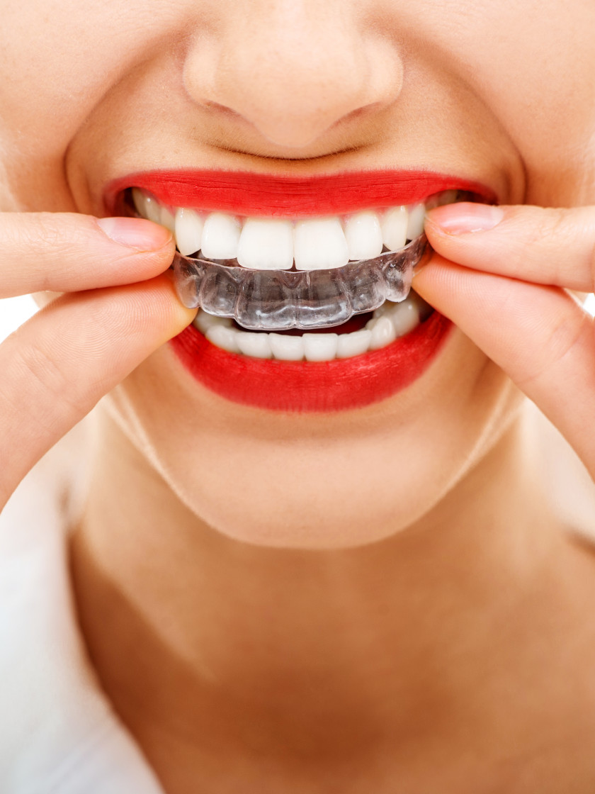 Teeth Orthodontics Clear Aligners Dental Braces Retainer Dentistry PNG