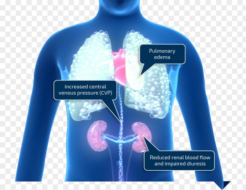 Heart Vein Ailment Medicine Dyspnea Pulmonary Embolism PNG