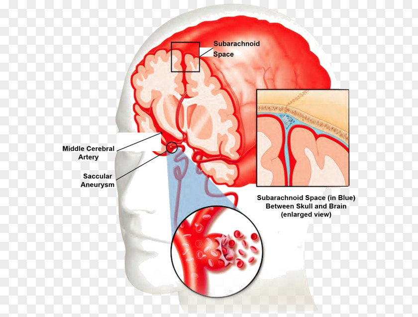 Blood Vessel Stroke Bleeding Brain PNG