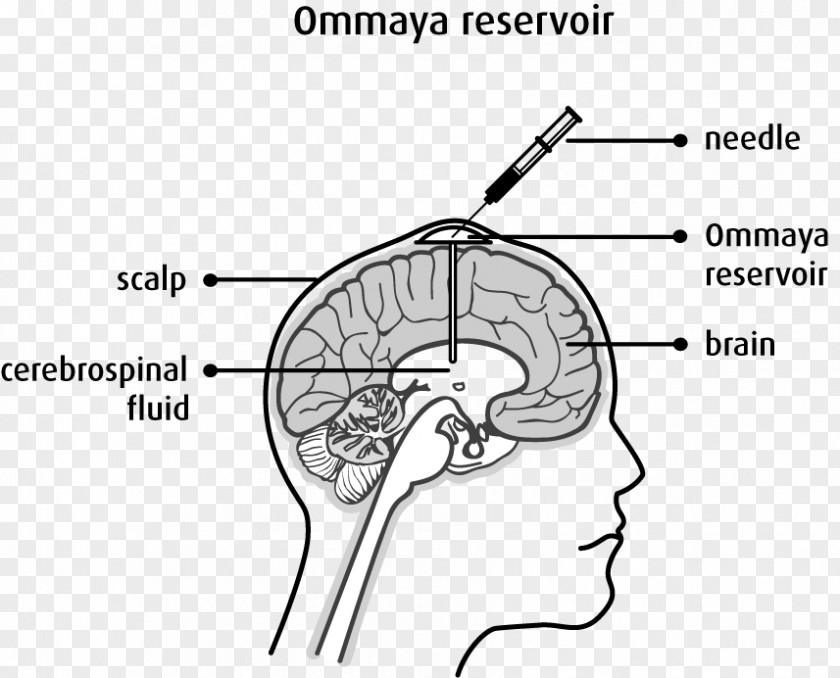 Ommaya Reservoir Intrathecal Administration Chemotherapy Cancer Brain Tumor PNG