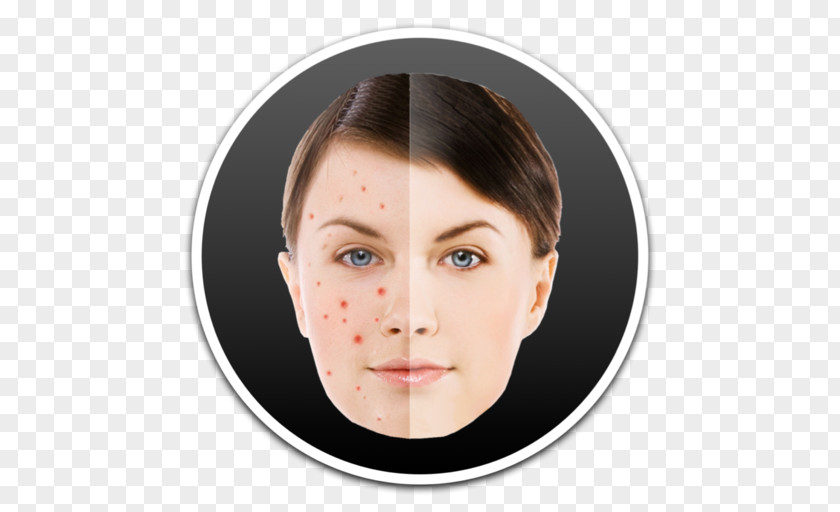 Pimple Acne Intense Pulsed Light PNG