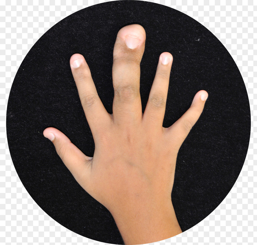 Hand Thumb Finger Local Gigantism Toe PNG