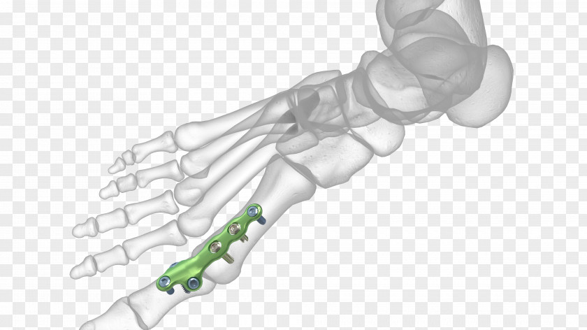 Plating Thumb Metatarsophalangeal Joints Arthrodesis Surgery PNG