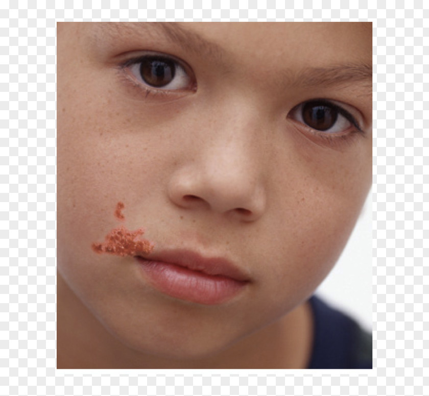 Dermatome Impetigo Herpes Labialis Skin Infection Cutaneous Condition PNG