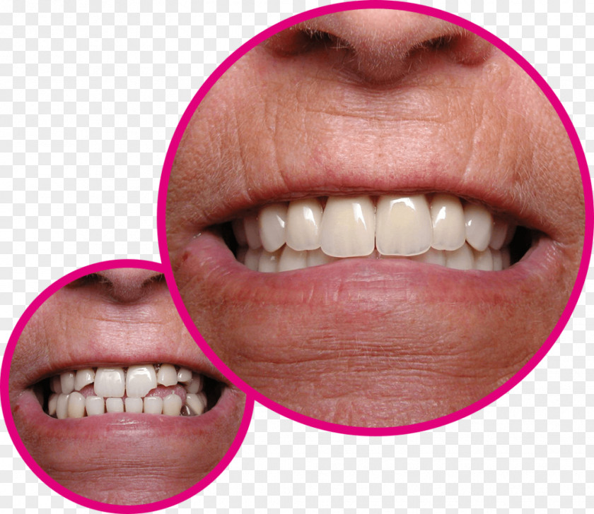 Crown Veneer Human Tooth Gums PNG