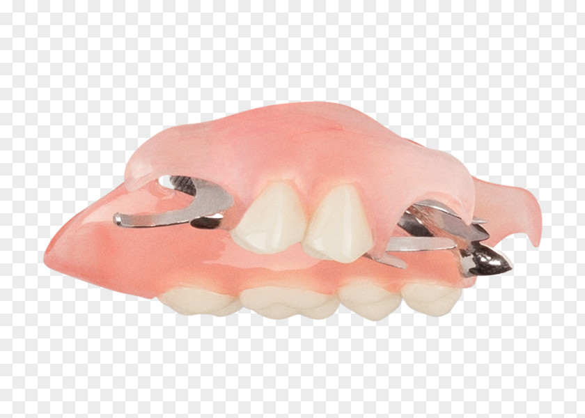 Top Angle Tooth Dentures Removable Partial Denture Dentistry Crown PNG